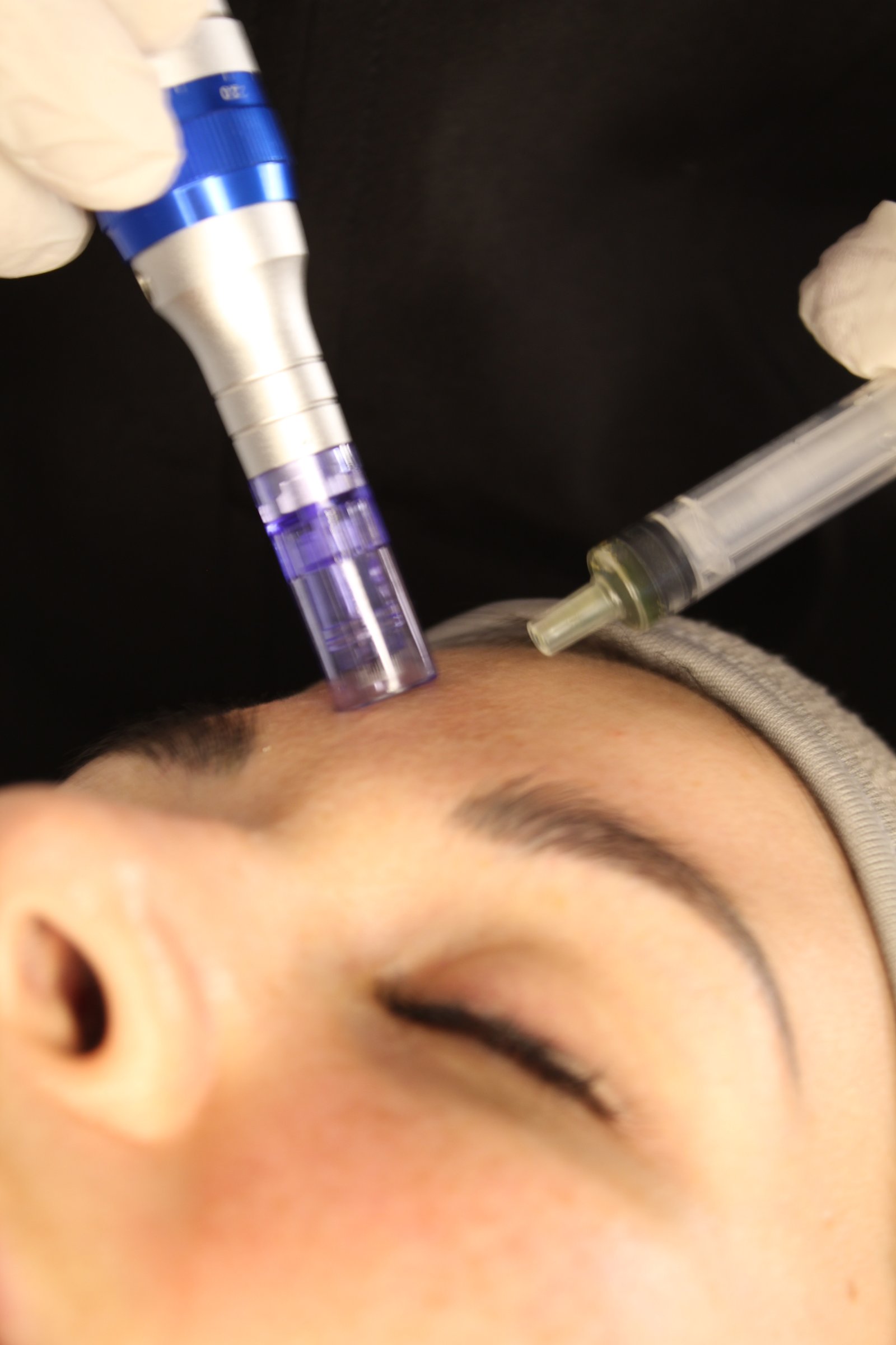 Microneedling